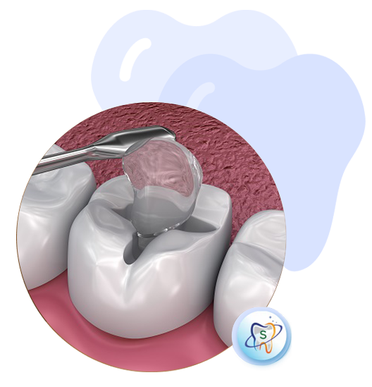 Dental Braces